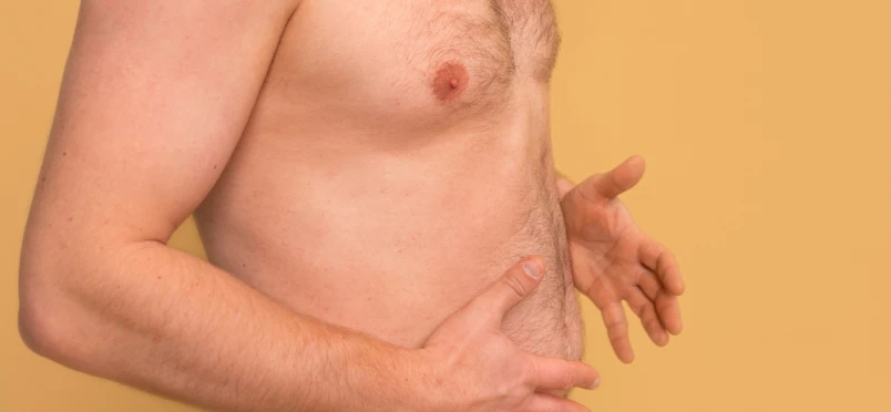 Gynecomastia