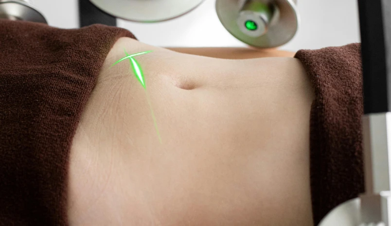 Laser Skin Resurfacing