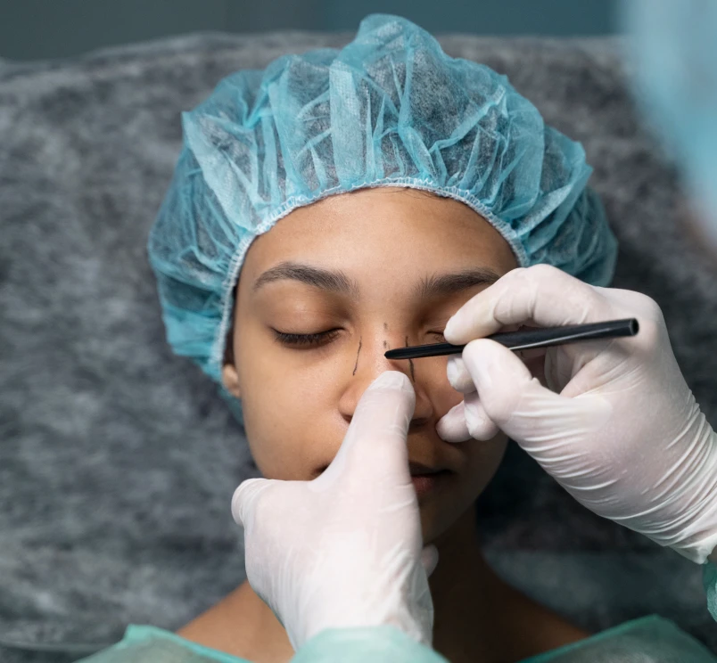 Rhinoplasty
