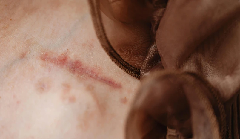 Scar Revision