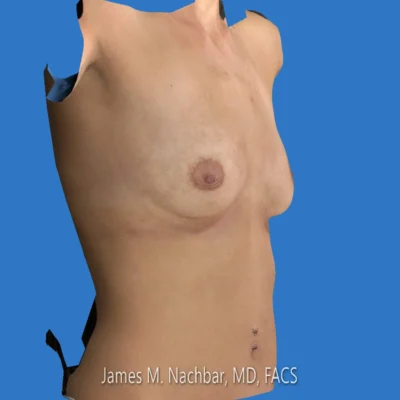 3-D Image Before