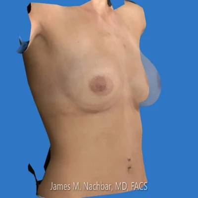 Surgical Simulation