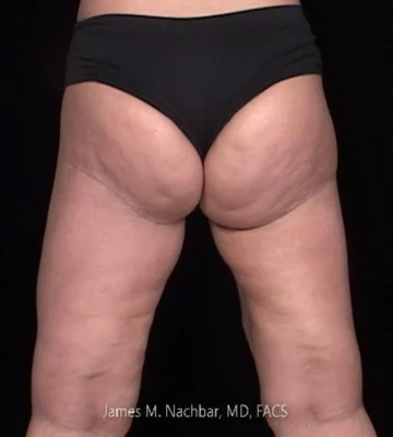 5 Months After
