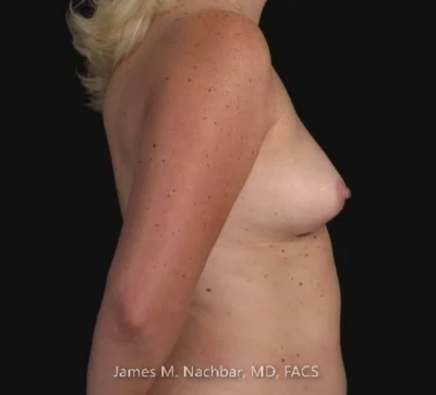 Before Augmentation