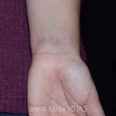 10 Months After