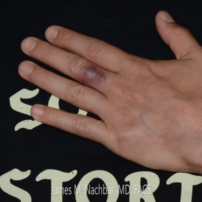 1 Month After