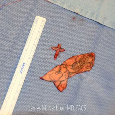 Tissue Removed