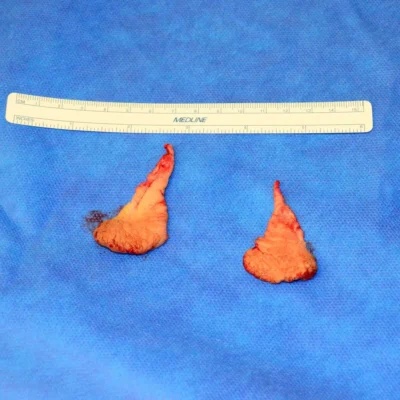 Tissue Removed