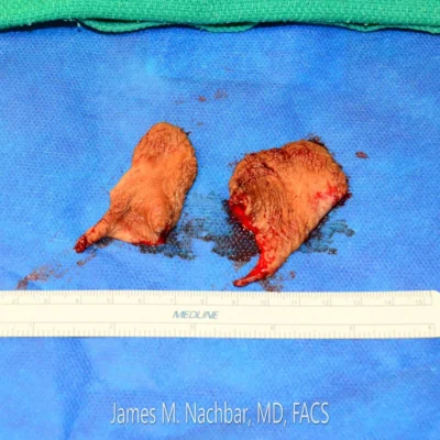 Tissue Removed