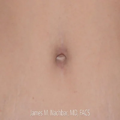 4 Months After