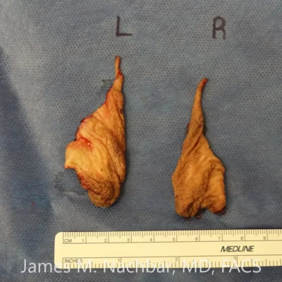 Tissue Removed