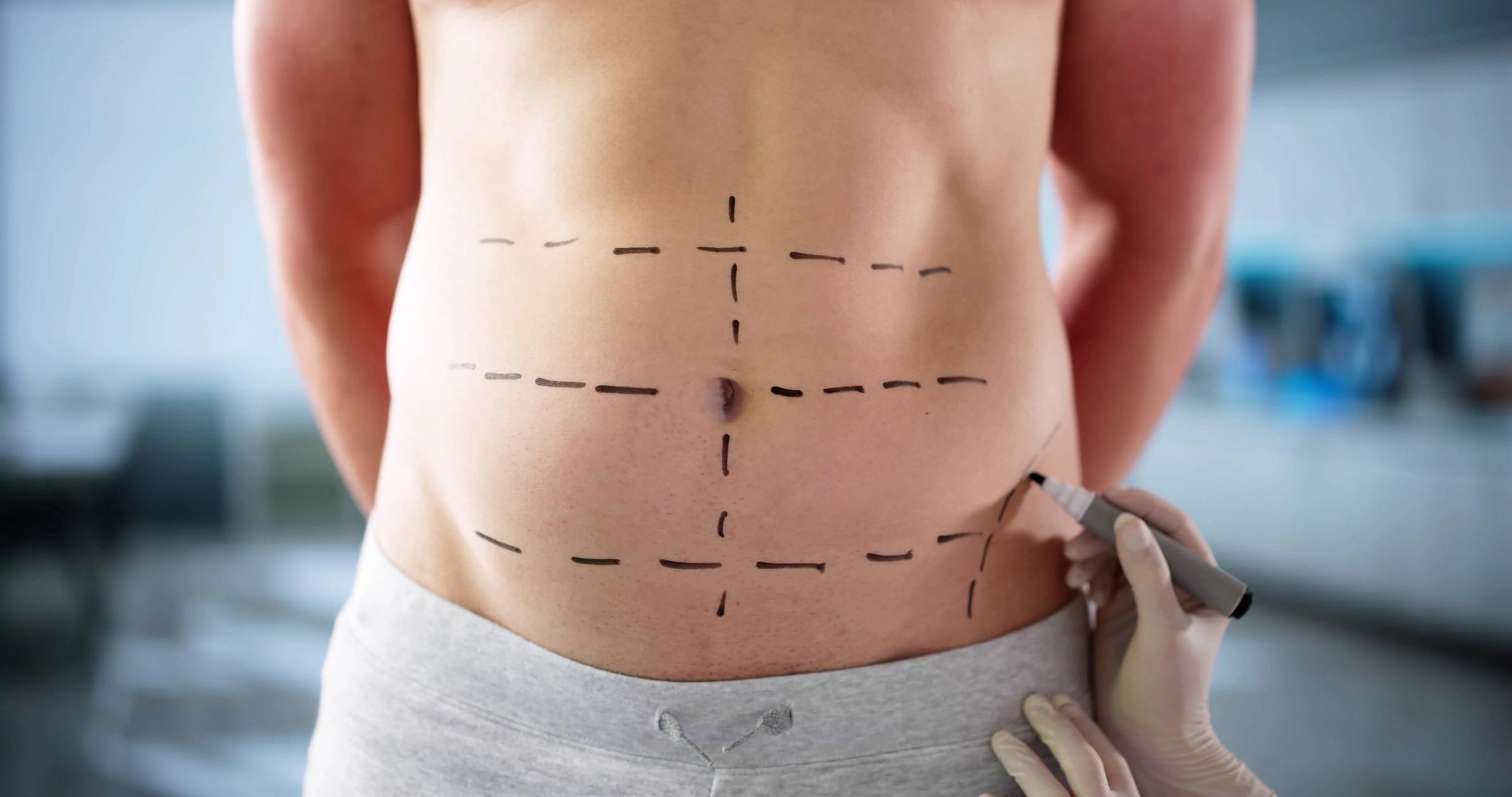 Tummy-Tuck